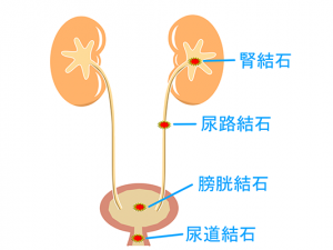 腎臓結石・尿管結石 | 埼玉県大宮駅と東京都上野駅の泌尿器科