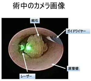 腎臓結石・尿管結石 | 埼玉県大宮駅と東京都上野駅の泌尿器科